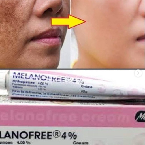 Melanofree Cream For Acne Scars